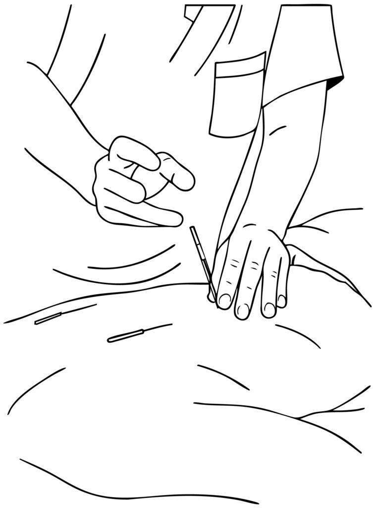 鍼灸師が鍼を丁寧に刺している手元のイラスト