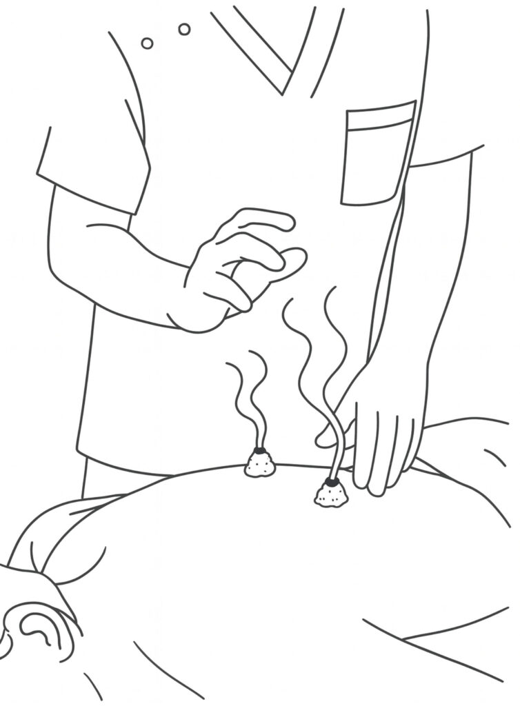 肩や背中にモグサを乗せて凝りや熱を抜くお灸をしているところ