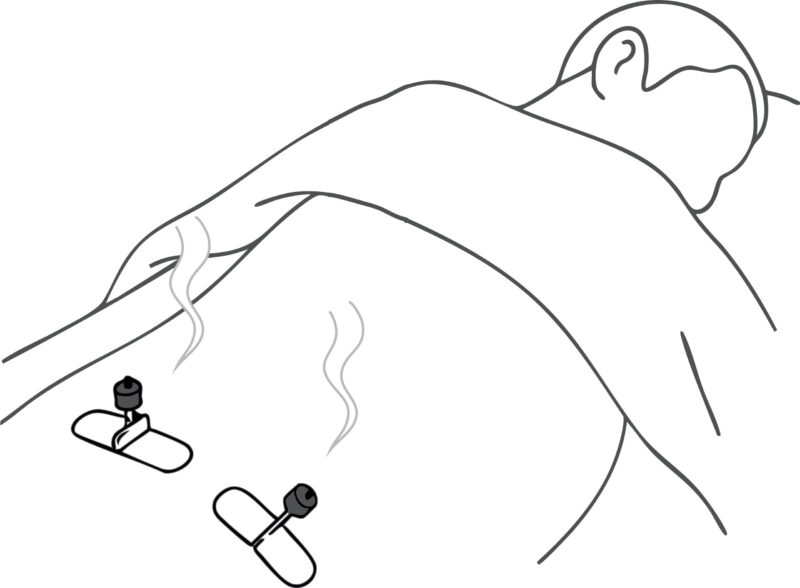 腰に鍼を刺し、その上に炭灸をのせている灸頭鍼のイラスト